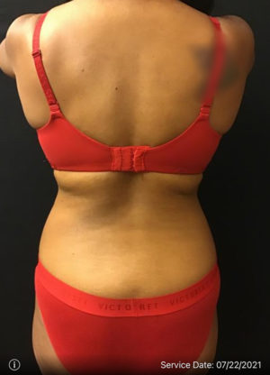 Liposuction