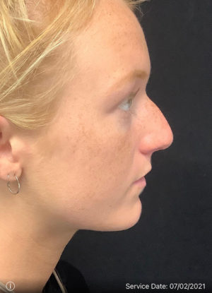 Rhinoplasty