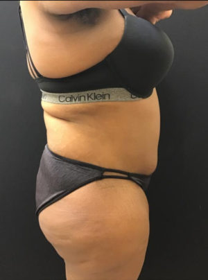Liposuction