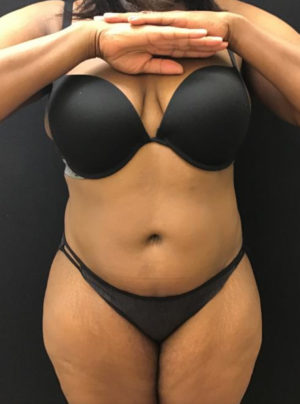 Liposuction