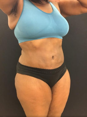 Liposuction