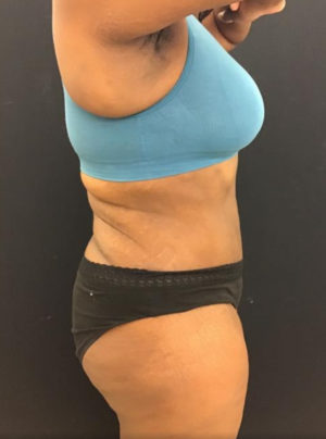 Liposuction