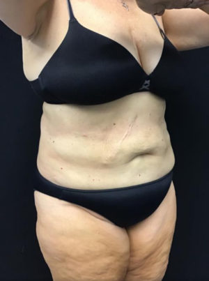 Liposuction