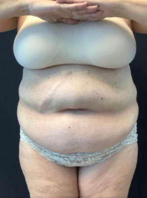 Liposuction