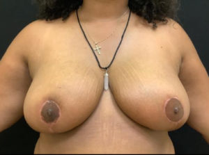 Breast Reduction