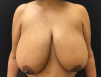 Breast Reduction