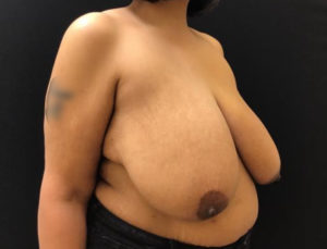 Breast Reduction