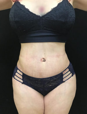 Tummy Tuck