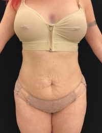 Tummy Tuck