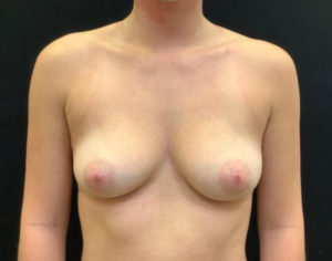 Breast Augmentation