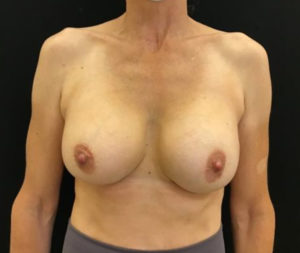 Breast Augmentation