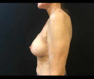 Breast Augmentation