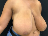 Breast Reduction