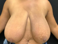 Breast Reduction