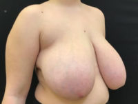 Breast Reduction