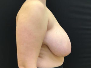 Breast Reduction