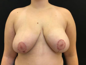 Breast Reduction