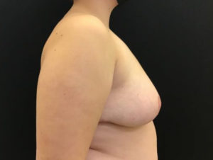Breast Reduction