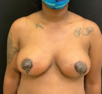 Breast Lift