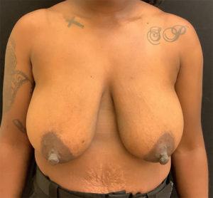 Breast Lift