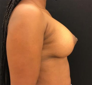 Breast Lift