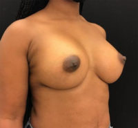 Breast Lift