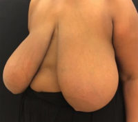 Breast Reduction