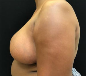 Breast Reduction