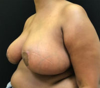 Breast Reduction
