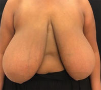 Breast Reduction