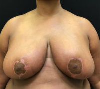 Breast Reduction