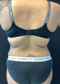 Tummy Tuck