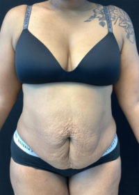 Tummy Tuck