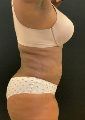 Liposuction