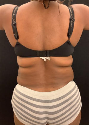 Liposuction