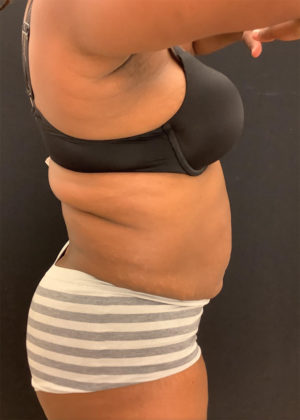 Liposuction