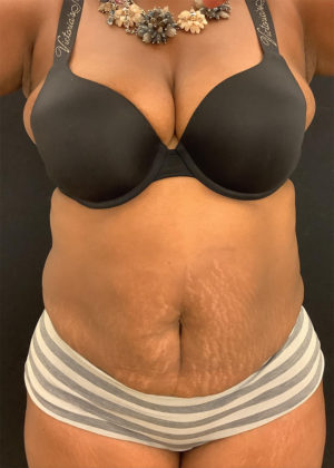Liposuction