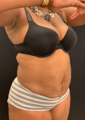 Liposuction