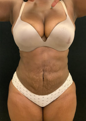 Liposuction
