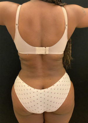 Liposuction