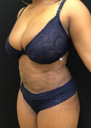 Liposuction