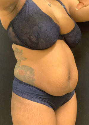 Liposuction