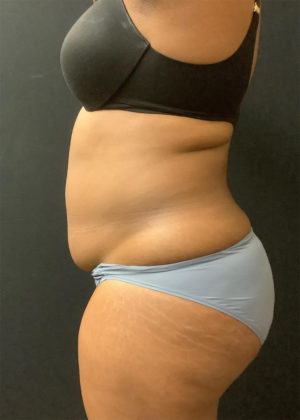 Liposuction