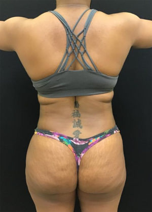 Liposuction