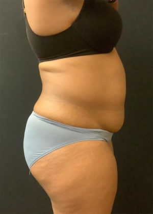 Liposuction