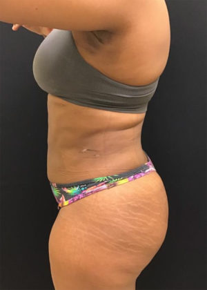 Liposuction