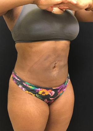 Liposuction