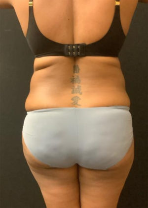 Liposuction
