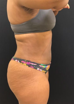 Liposuction