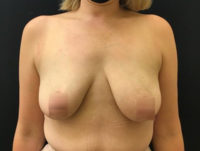 Breast Augmentation